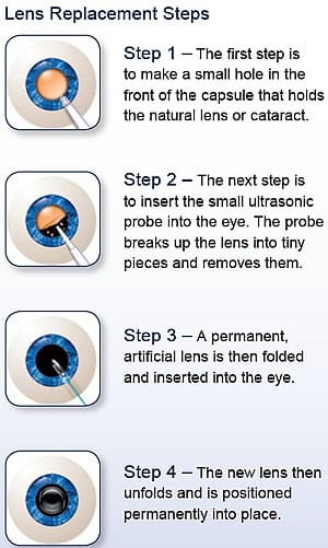 What is a good treatment procedure for cataracts?