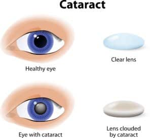 Cataract | Cataract Surgery Greenfield MA