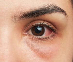 Eye Twitching | Eye Care Services Greenfield MA